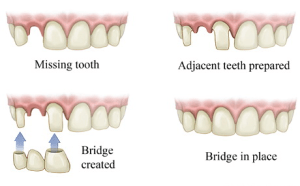 Diagram showing the process of placing a dental bridge