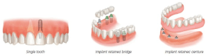 Dental implant diagrams