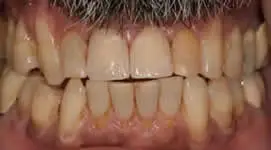 Patient's mouth after anterior incisors extraction and implant placement with crowns