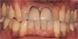 Patient's mouth before anterior incisors extraction and implant placement with crowns