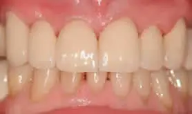 Patient's mouth after ceramic crowns
