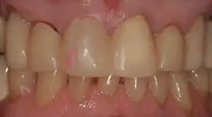 Patient's mouth before ceramic crowns