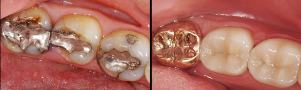Patient's teeth before and after ceramci and gold crowns