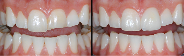 Patient's mouth before and after a ceramic crown