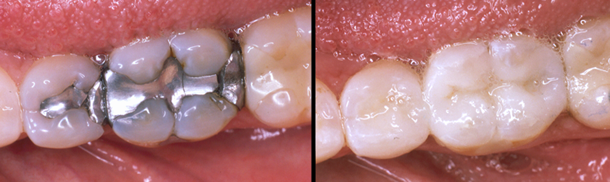 Patient's teeth before and after ceramic onlays