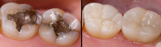 Patient's teeth before and after ceramic onlays/crowns