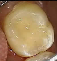 Patient's tooth after composite restoration