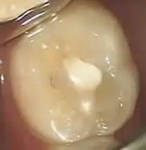 Patient's tooth before composite restoration