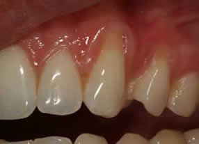 Patient's mouth before a connective tissue graft