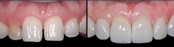 Patient's teeth before and after diastema closure with veneers