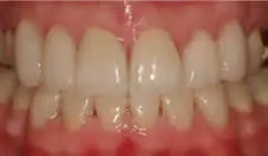 Patient's mouth after full mouth reconstruction
