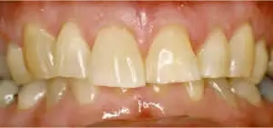 Patient's mouth before full mouth reconstruction