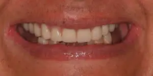 Patient's mouth after full mouth reconstruction