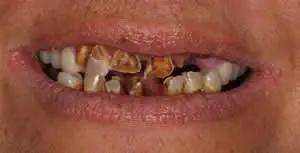 Patient's mouth before full mouth reconstruction