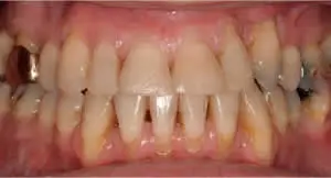 Patient's mouth after full mouth reconstruction