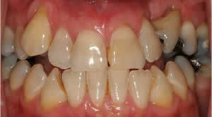 Patient's mouth before full mouth reconstruction