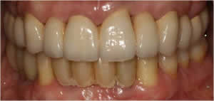 Patient's mouth after full mouth reconstruction