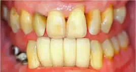 Patient's mouth before full mouth reconstruction