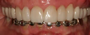 Patient's mouth after full mouth reconstruction