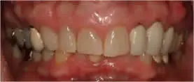 Patient's mouth before full mouth reconstruction