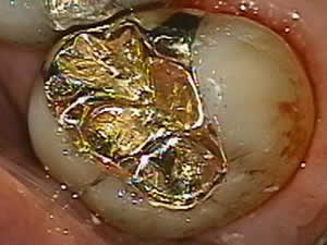 Patient's tooth after gold inlay restoration