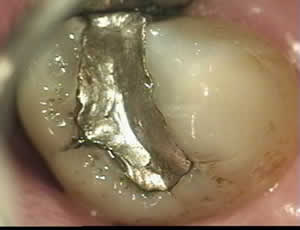 Patient's tooth before gold inlay restoration