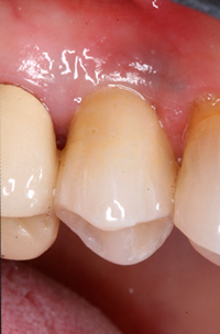 Patient's mouth after an implant abutment and crown