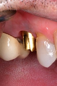 Patient's mouth before an implant abutment and crown