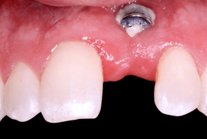 Implant placed in growing child
