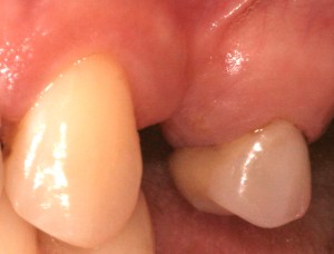 Example of gum recession