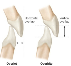 Diagram showing the position of teeth with an overjet and overbite