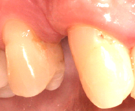 Example of teeth and gums without adequate space for an implant