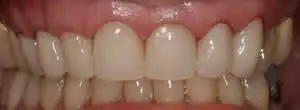 Patient's mouth after upper anterior reconstruction