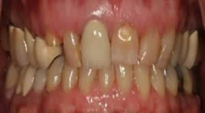 Patient's mouth before upper anterior reconstruction