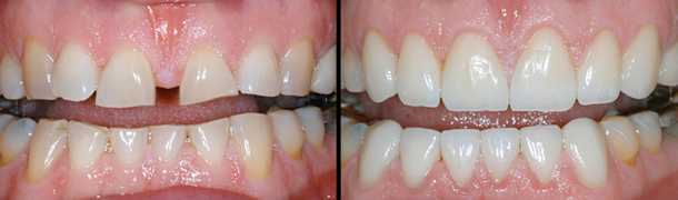 Patien't's mouth before and after upper and lower veneers