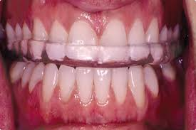Occlusal splint in a mouth