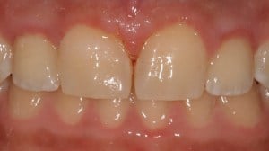 Patient's teeth with implants placed by our practice