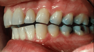 Worn teeth due to attrition