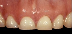 Eroded teeth due to bulemia