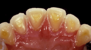 Eroded teeth due to bulemia