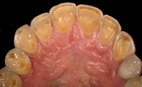 Worn teeth due to erosion