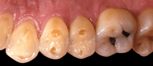 Eroded teeth
