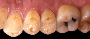 Eroded teeth