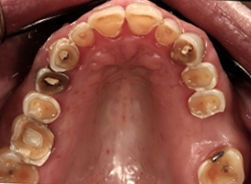 Eroded teeth due to gastric reflux