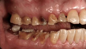 Eroded teeth due to gastric reflux