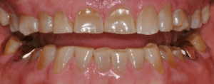 Eroded teeth due to soda