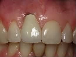 Patient's teeth with implant placed by another practice