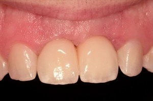 Patient's teeth with implant placed by another practice