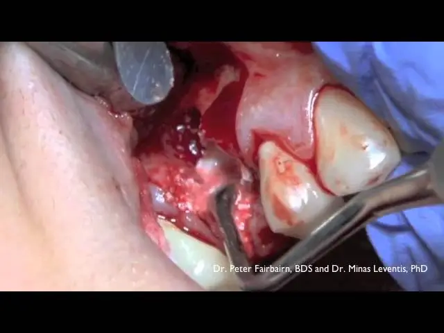 Ethoss Pre-Molar Case